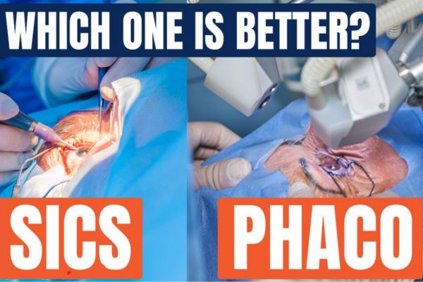 Cataract Surgery (SICS & PHACO)